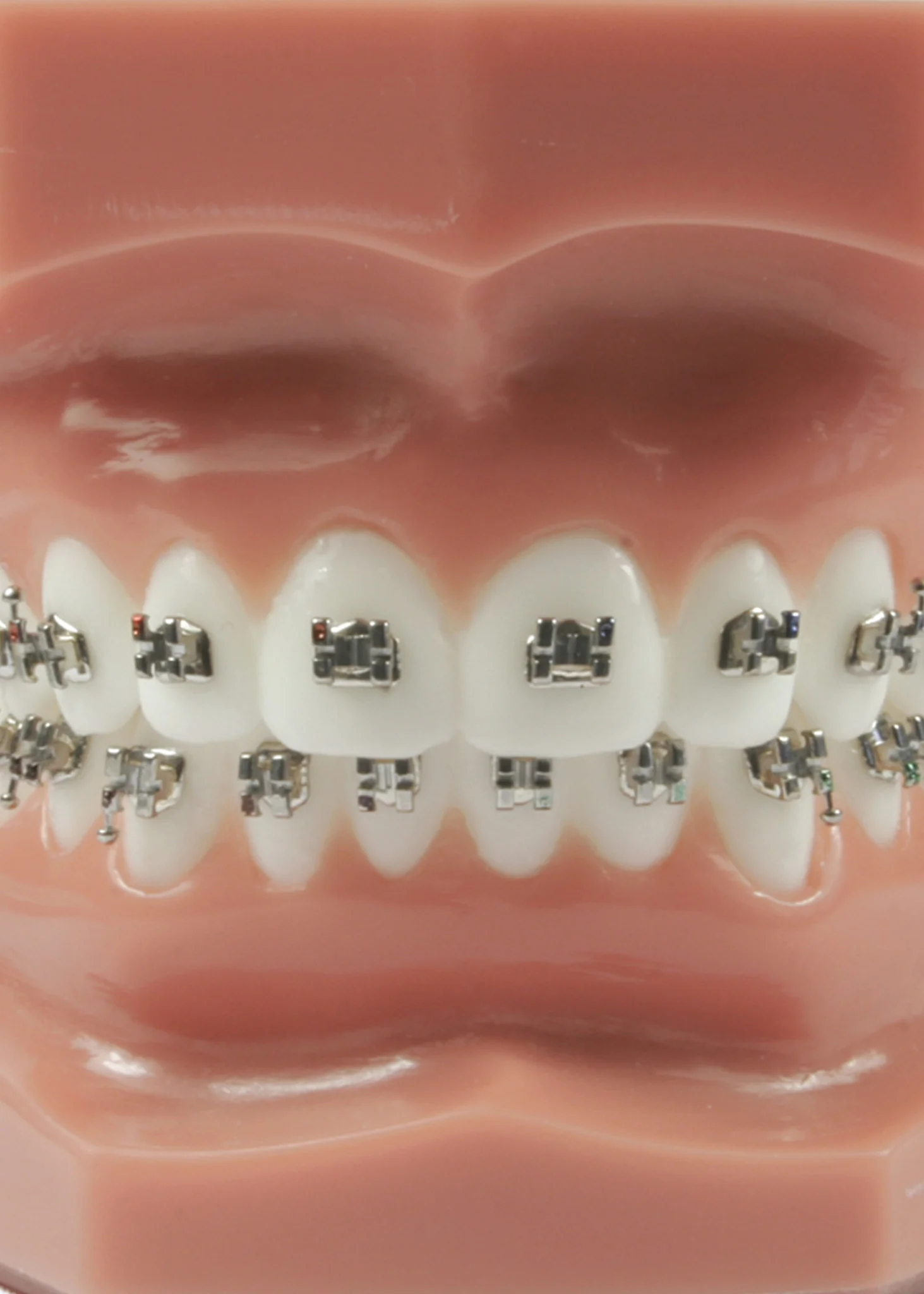 Evolve Mini Brackets - Case Kit - Image 3